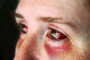 Laser Eye Surgery Complications