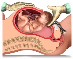 Obstetric Gynaecological Claim