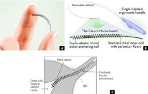 Essure Hysteroscopic Sterilisation